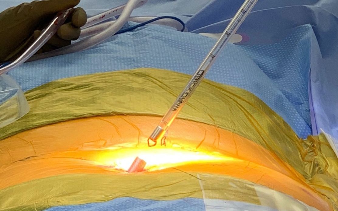 QuickDraw Bone Graft Harvester with Percutaneous technique through Cannulae. 